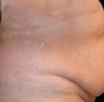 Tummy Tuck Before & After Patient #729