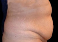Tummy Tuck Before & After Patient #729