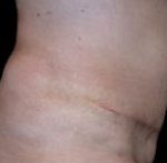Tummy Tuck Before & After Patient #729
