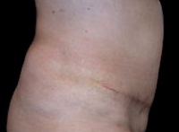 Tummy Tuck Before & After Patient #729