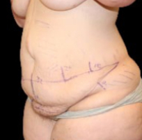Tummy Tuck Before & After Patient #731