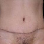Tummy Tuck Before & After Patient #732