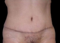 Tummy Tuck Before & After Patient #732