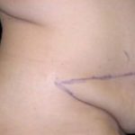 Tummy Tuck Before & After Patient #737