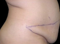 Tummy Tuck Before & After Patient #737