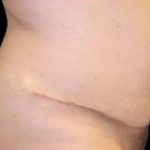 Tummy Tuck Before & After Patient #737