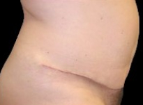 Tummy Tuck Before & After Patient #737