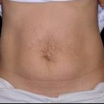 Tummy Tuck Before & After Patient #738