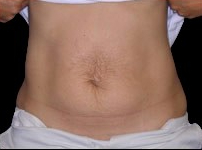 Tummy Tuck Before & After Patient #738