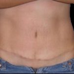Tummy Tuck Before & After Patient #738
