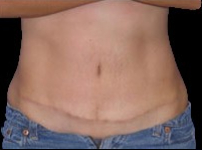 Tummy Tuck Before & After Patient #738