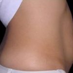 Tummy Tuck Before & After Patient #738