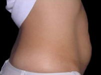 Tummy Tuck Before & After Patient #738