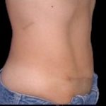 Tummy Tuck Before & After Patient #738