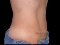 Tummy Tuck Before & After Patient #738
