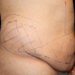 Tummy Tuck Before & After Patient #739