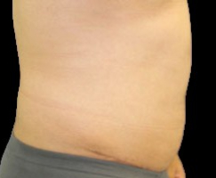 Tummy Tuck Before & After Patient #739
