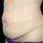 Tummy Tuck Before & After Patient #740