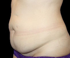 Tummy Tuck Before & After Patient #740