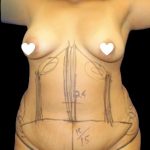 Tummy Tuck Before & After Patient #741