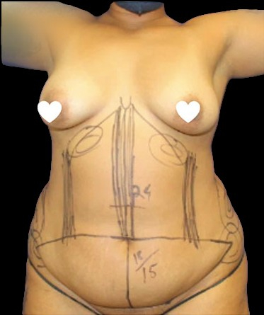Tummy Tuck Before & After Patient #741