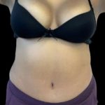 Tummy Tuck Before & After Patient #741