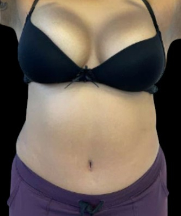 Tummy Tuck Before & After Patient #741