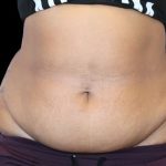Tummy Tuck Before & After Patient #742