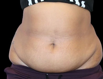 Tummy Tuck Before & After Patient #742