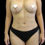 Tummy Tuck Before & After Patient #743