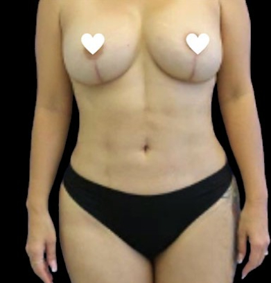 Tummy Tuck Before & After Patient #743