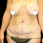 Tummy Tuck Before & After Patient #744