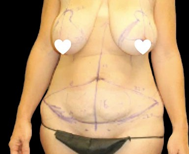 Tummy Tuck Before & After Patient #744