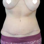 Tummy Tuck Before & After Patient #744