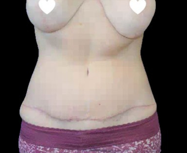 Tummy Tuck Before & After Patient #744