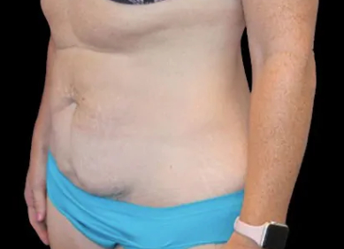 Tummy Tuck Before & After Patient #746