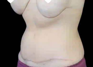 Tummy Tuck Before & After Patient #746