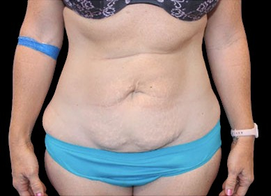 Tummy Tuck Before & After Patient #746