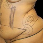 Tummy Tuck Before & After Patient #747