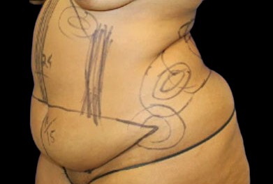 Tummy Tuck Before & After Patient #747