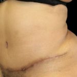 Tummy Tuck Before & After Patient #747