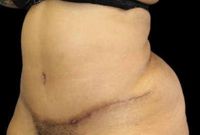 Tummy Tuck Before & After Patient #747