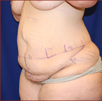 Tummy Tuck Before & After Patient #731
