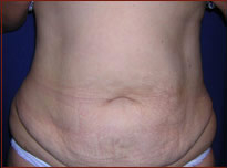 Tummy Tuck Before & After Patient #732