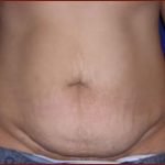 Tummy Tuck Before & After Patient #733