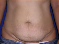 Tummy Tuck Before & After Patient #733