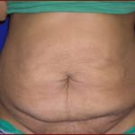 Tummy Tuck Before & After Patient #734