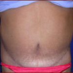 Tummy Tuck Before & After Patient #735