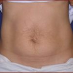 Tummy Tuck Before & After Patient #738