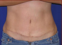 Tummy Tuck Before & After Patient #738